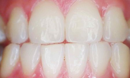 Scaling zębów - zdrowe zęby